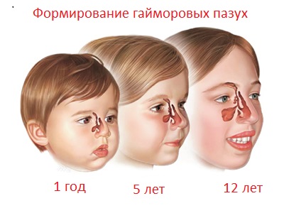 Формирование гайморовых пазух у детей