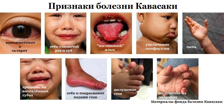 кавасаки, синдром кавасаки, болезнь кавасаки, конъюнктивит, склерит, кавасаки у детей, малиновый язык, шелушение кожи, лимфаденит, лимфоузлы, болезнь, ребёнок заболел