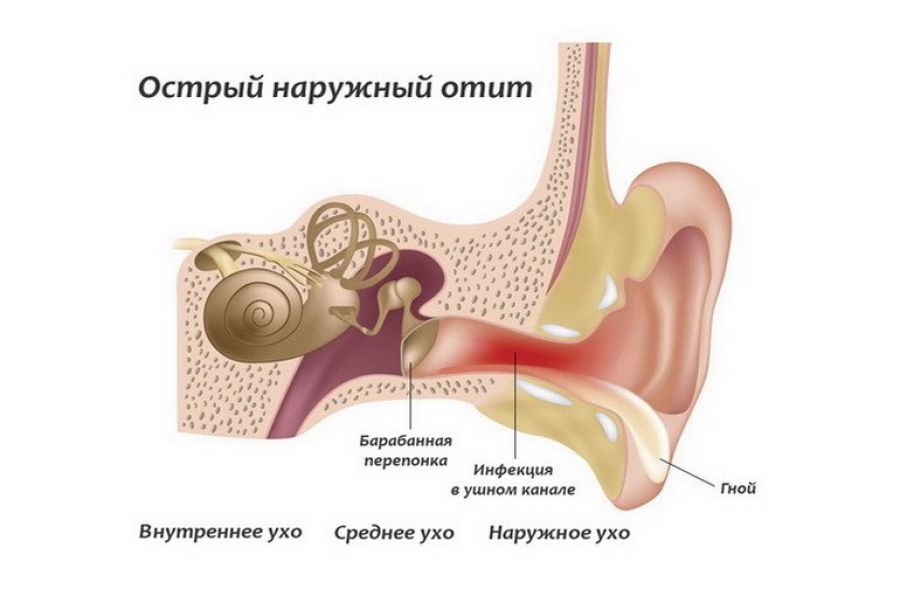 острый наружный отит строение уха и отит