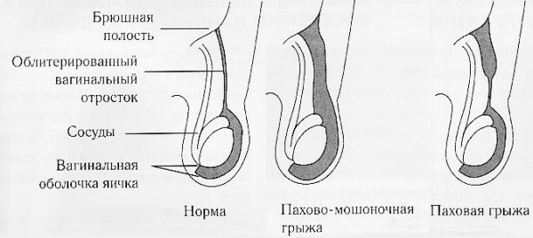 Строение грыж