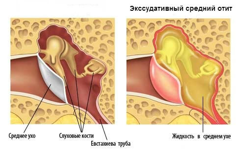 экссудативный средний отит экссудативный средний отит