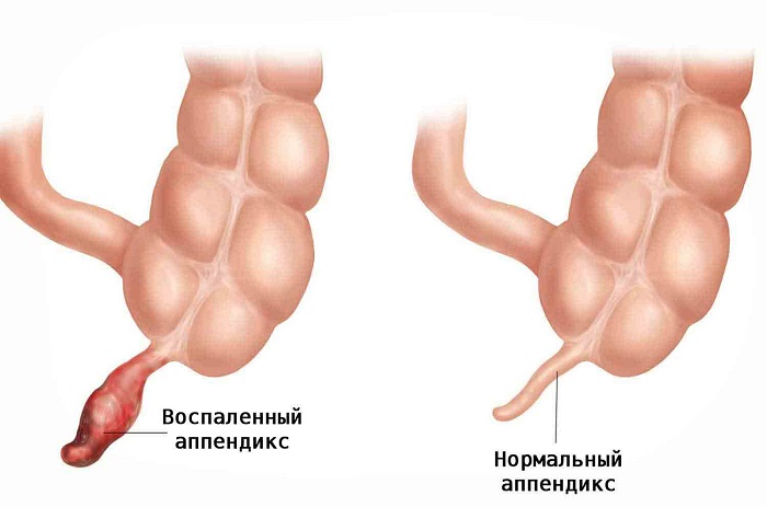 Как выглядит воспаленный аппендикс