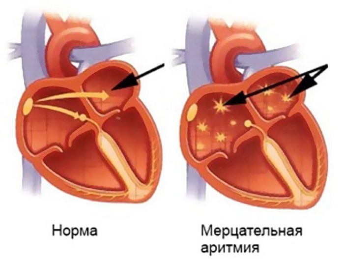 Мерцательная аритмия на картнке Мерцательная аритмия