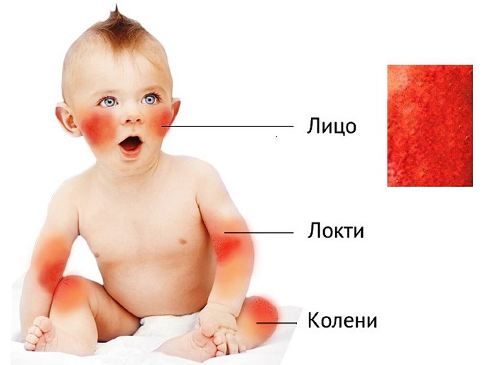 Места появления диатеза у детей Где появляется у ребенка диатез
