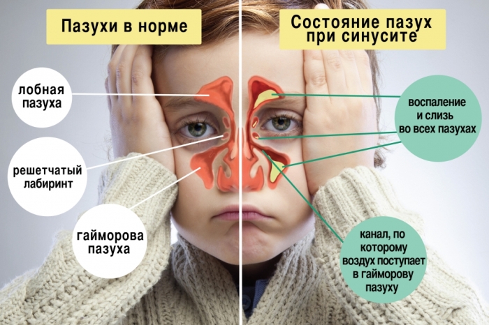 Состояние пазух при синусите Пазухи в норме и при синусите