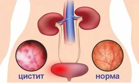 Как заболевают циститом Боли при цистите у женщин