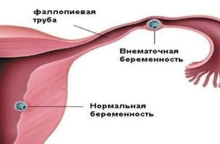 Внематочная беременность Беременность неделям: боль животе