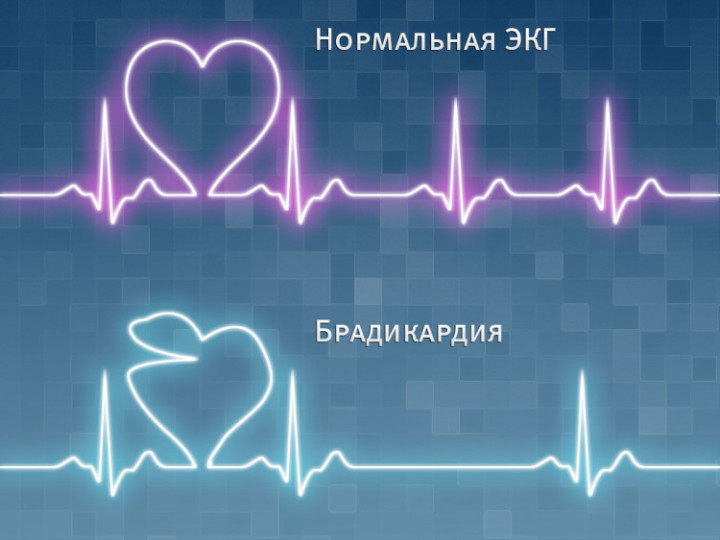 Сравнение ЭКГ