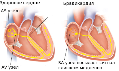 Здоровое сердце и сердце с брадикардией
