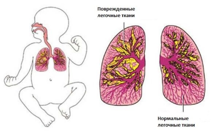 Схема бронхолегочной дисплазии Нормальные и поврежденные легочные ткани