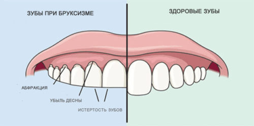 Отличие зубов при бруксизме Особенность бруксизма