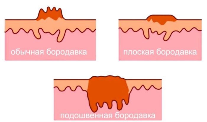 Формы бородавок