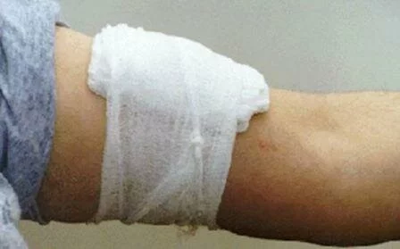 Как наложить давящую повязку при кровотечении Давящая повязка