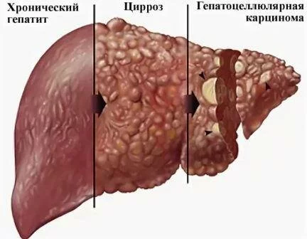 Главные причины диффузных изменений печени Диффузные изменения паренхимы печени поджелудочной железы