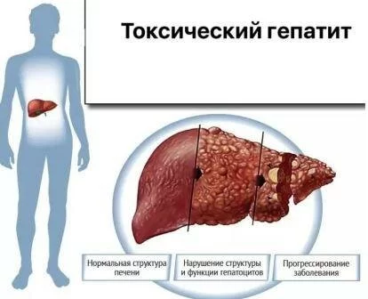 Диффузно очаговая трансформация Умеренные диффузные изменения паренхимы печени
