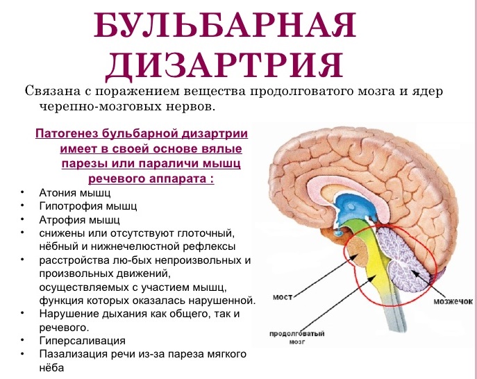 бульбарная дизартрия бульбарная дизартрия в картинке