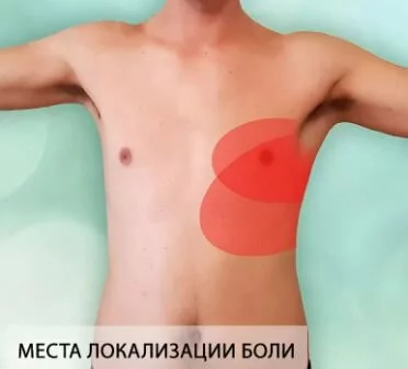 Межреберная невралгия Помощь при болях в сердце