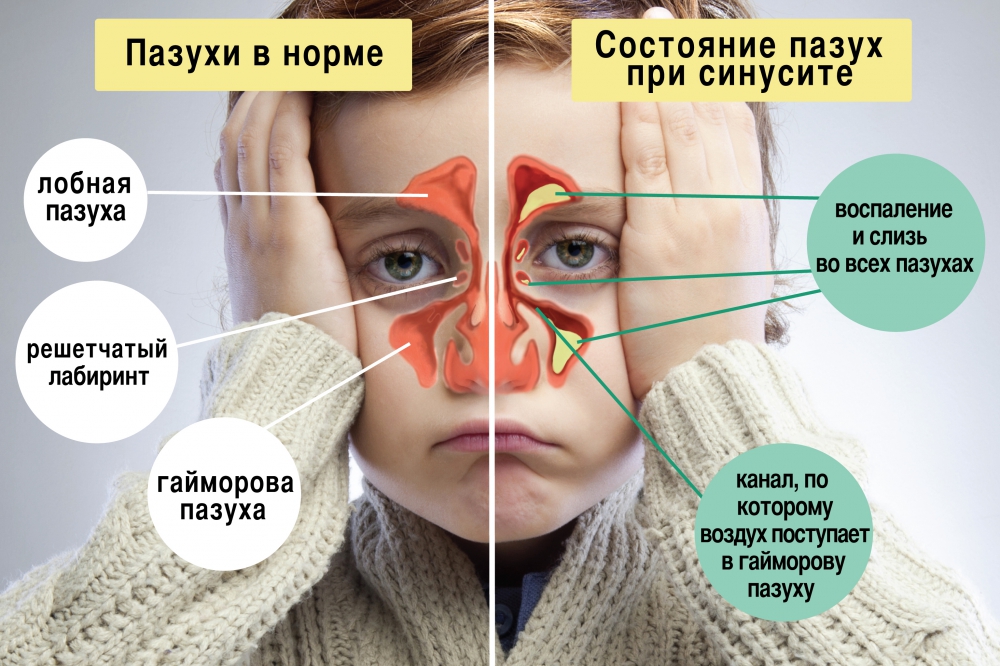 Сравнение пазух у ребенка при болезни и без нее