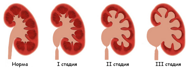 Стадии гидронефроза Стадии гидронефроза у детей