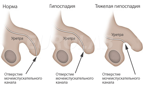 Мошонка с гипоспадией и без, сравнение Гипоспадия