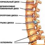 Грыжа