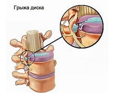 Грыжа диска