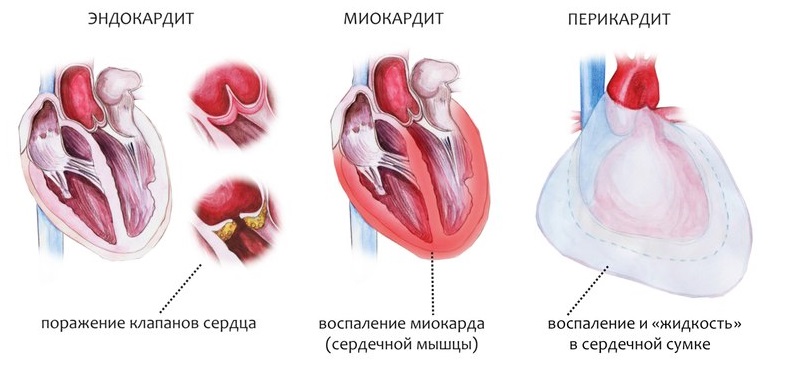 Эндокардит, миокардит и перикардит, сравнение Сравнение болезней