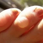 Как лечить водяную мозоль на ногах Как лечить водяную мозоль на ногах
