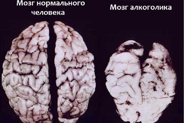 Можно ли пить пиво каждый день Как пиво влияет на мозг