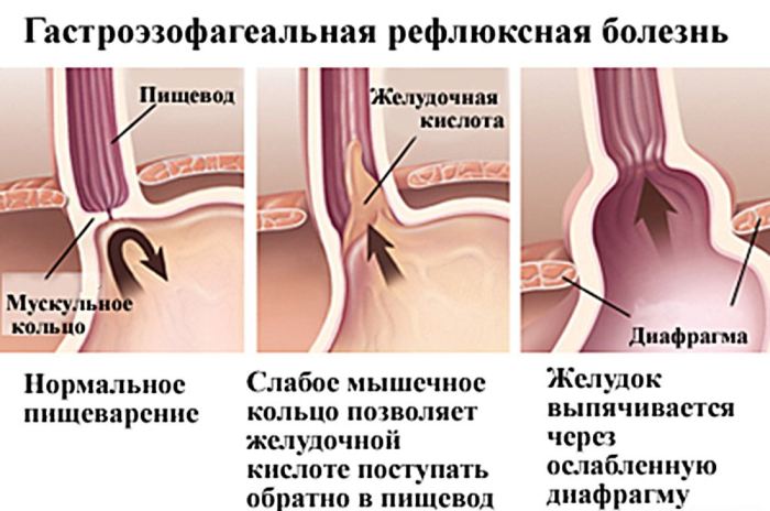 Гастроэзофагеальный рефлюкс Схема гастроэзофагеального рефлюкса