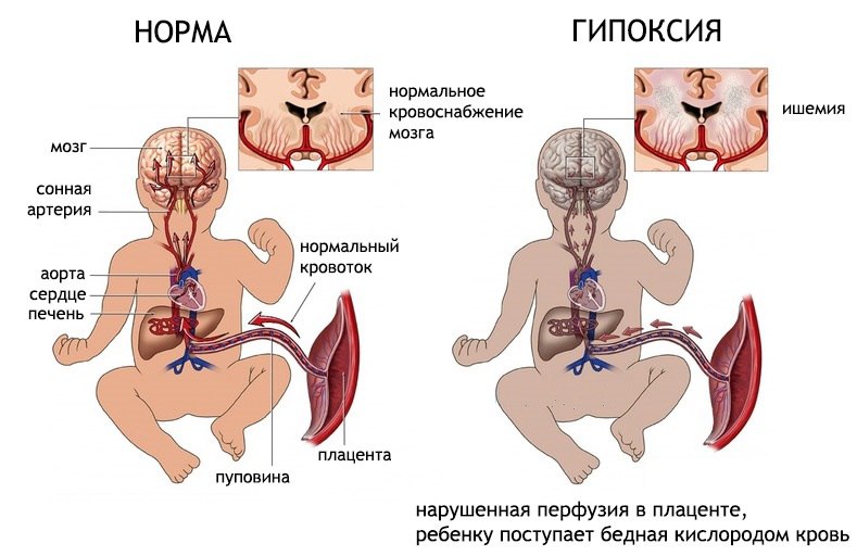 Гипоксия плода - нехватка кислорода малышу Гипоксия плода