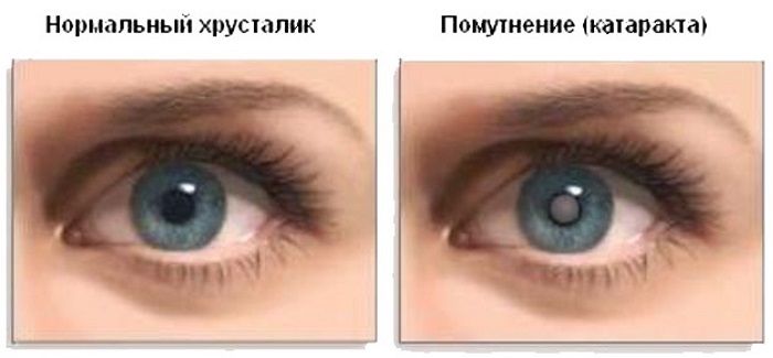 Сравнение катаракты с номальным глазом Катаракта у человека