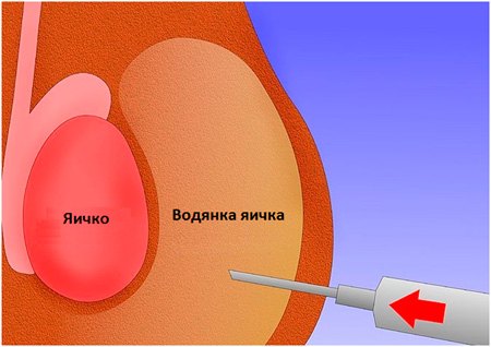 Операция с яичком Операция