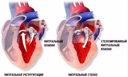Симптомы и признаки митрального стеноза Клиническая картина митрального стеноза