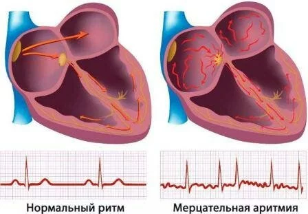 Осложнения Клиническая картина митрального стеноза