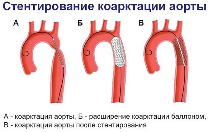 Стентирование коарктации аорты Стентирование коарктации аорты на фото