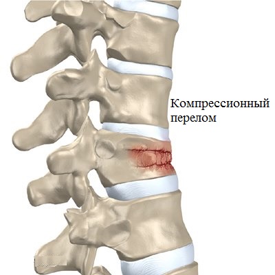 kompressionnii perelom