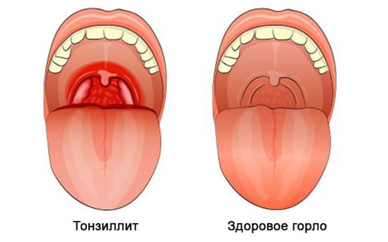 Тонзиллит у ребенка