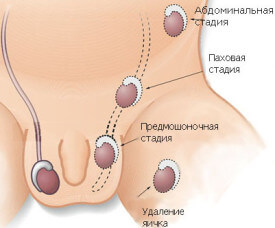 Стадии крипторхизма Стадии крипторхизма