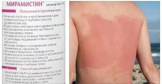 Как правильно использовать Мирамистин при ожогах Мирамистин помогает от ожогов