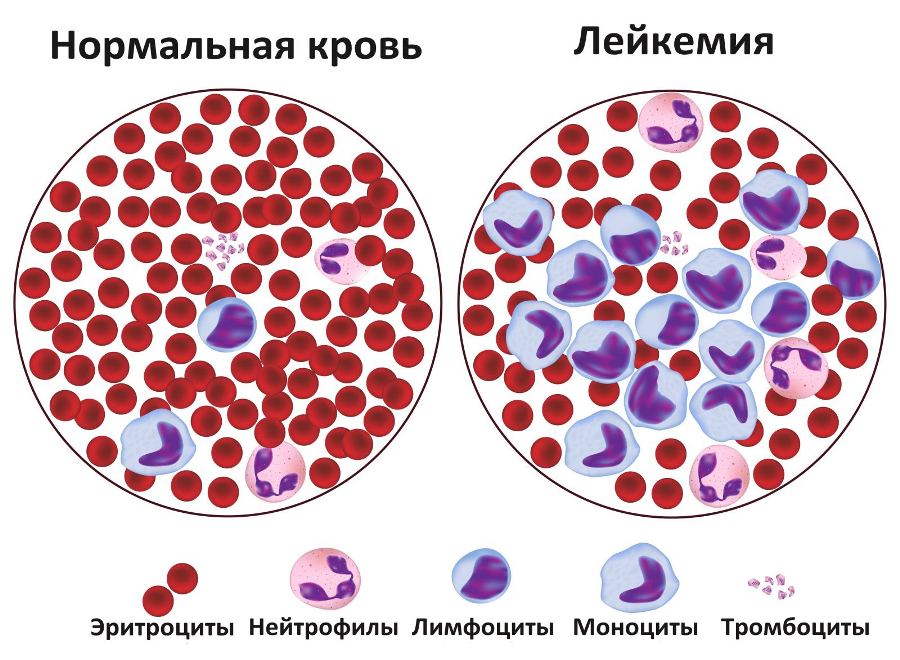 Кровь здорового ребенка и больного лейкемией Нормальная кровь ребенка и больного лейкемией