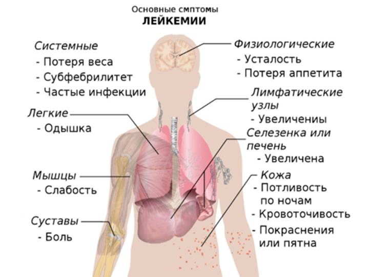 Симптомы лейкемии Симптомы лейкемии у детей
