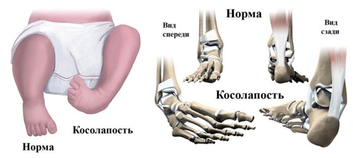 норма и косолапость норма и косолапость у ребенка