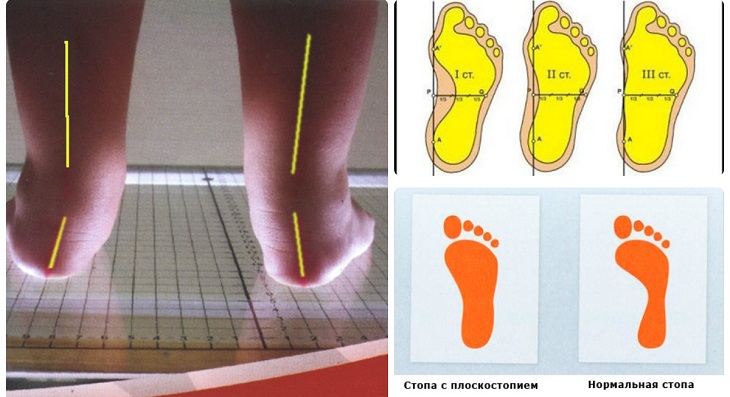 Самостоятельное определение плоскостопия у ребенка