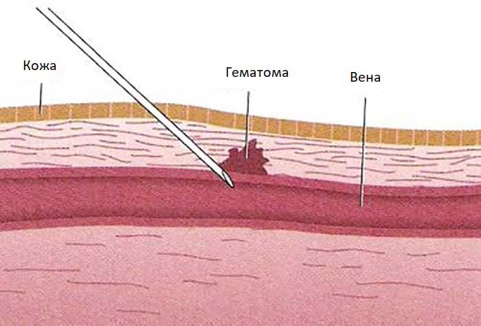 Народные средства от гематом