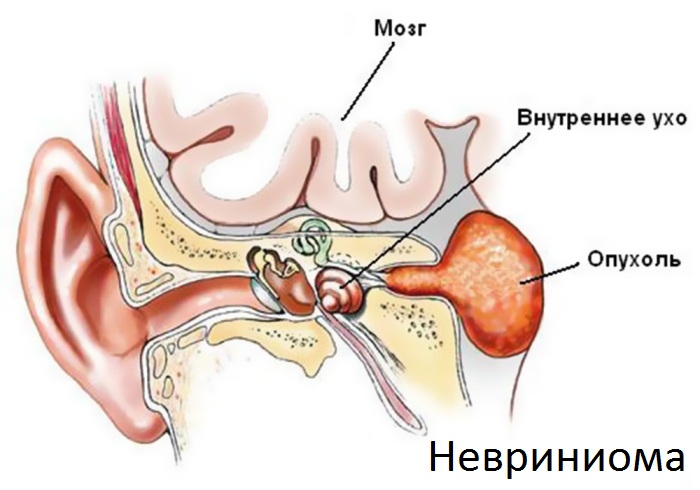 Невриниома Схема невриниомы