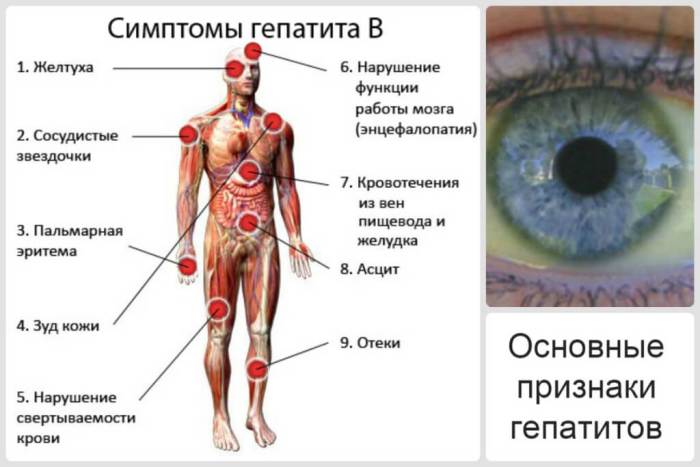 Симптомы гепатита В Перечень симптомов при гепатите В