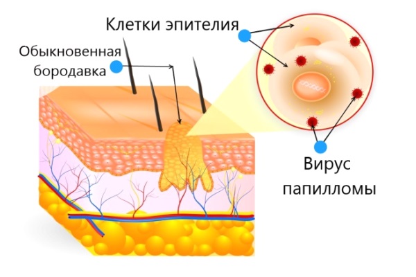 Схема вируса папилломы