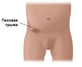 Паховая грыжа