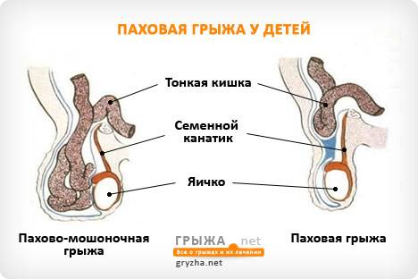 Не затягивайте лечение грыжи! Схема расположения паховой грыжи